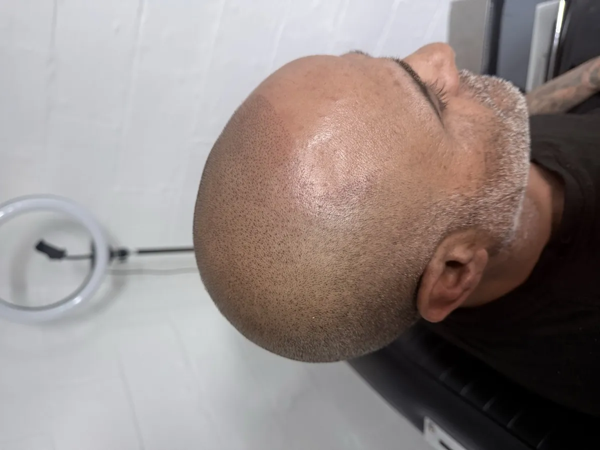 Completed full scalp SMP — side profile