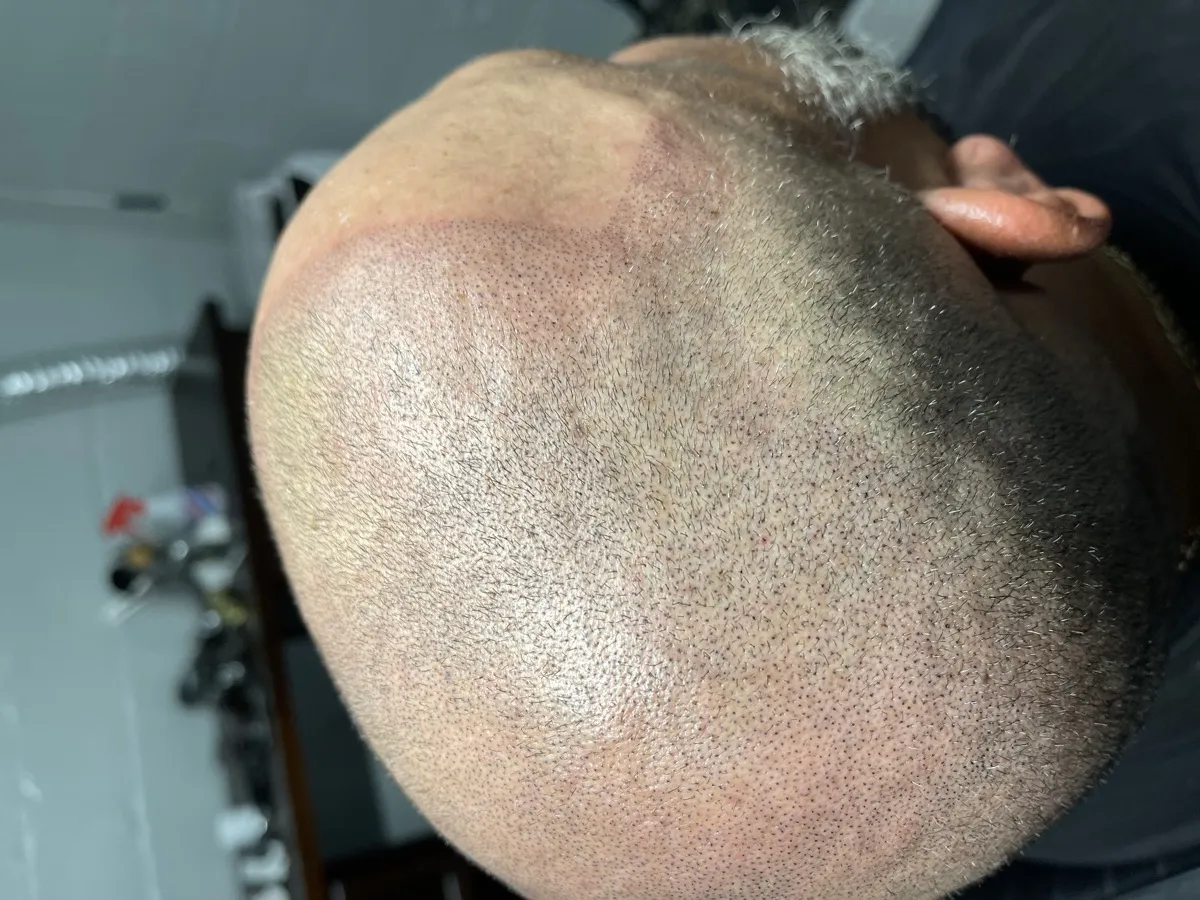 Completed full scalp SMP — top view