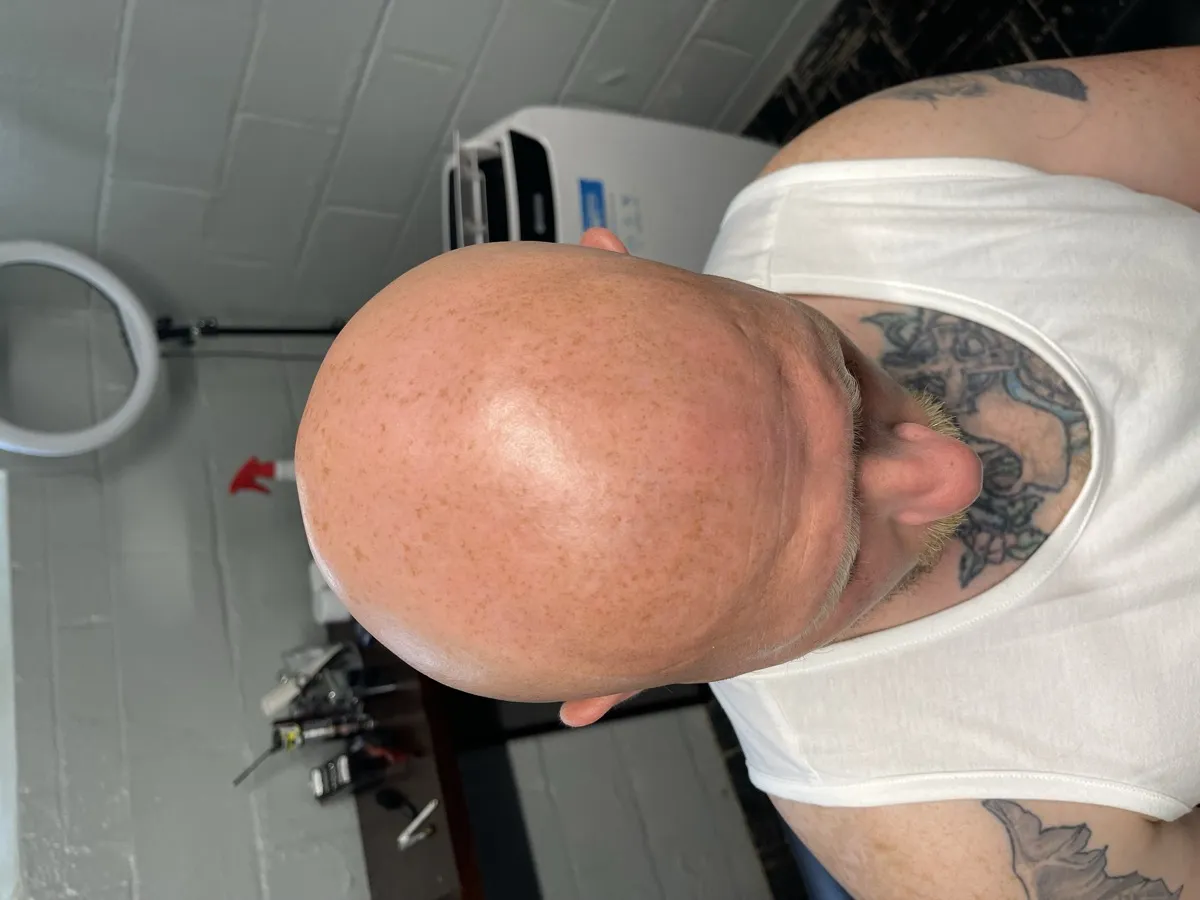 Before — completely bald scalp, front view