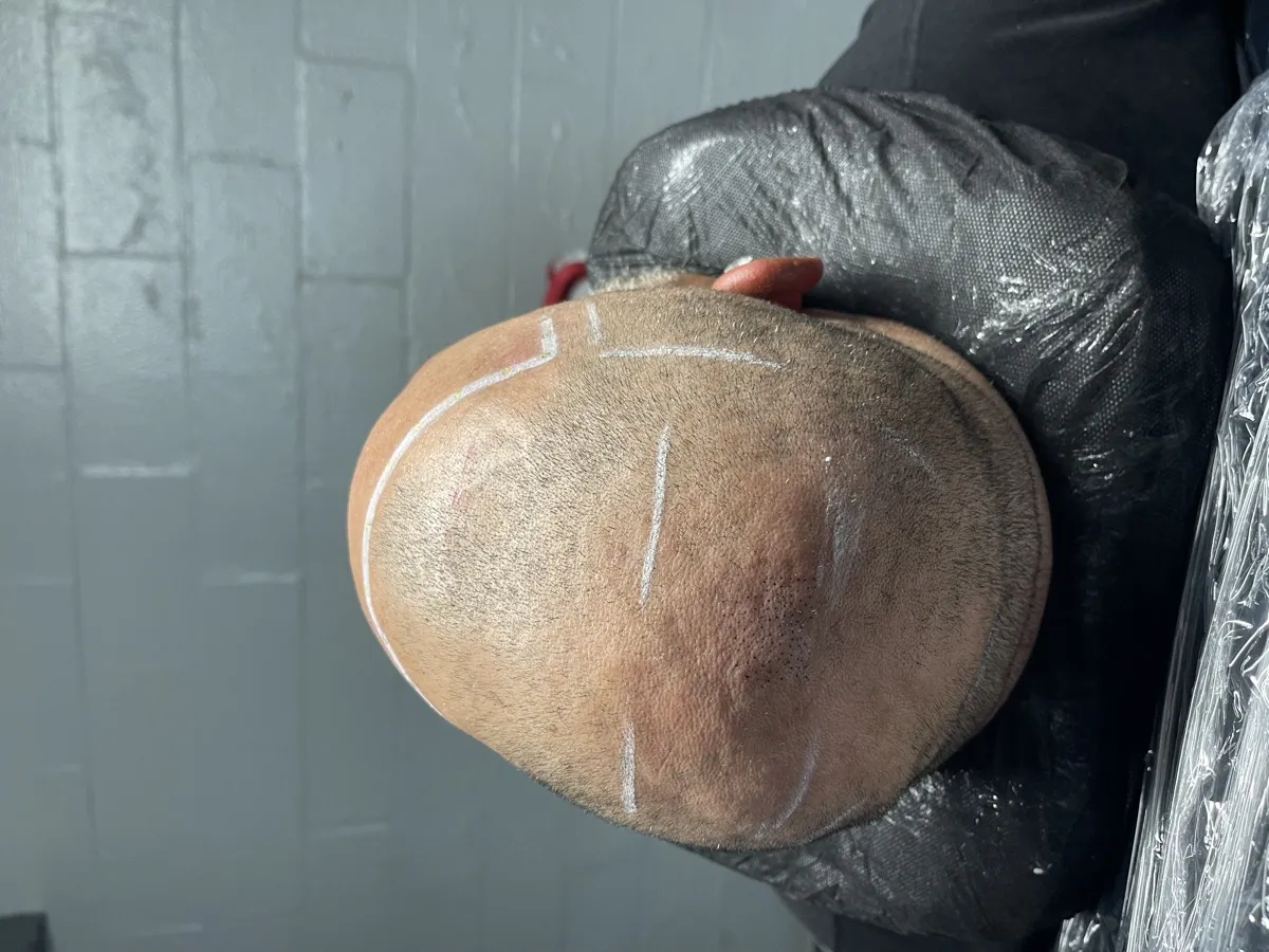 Before — bald scalp with guideline markings