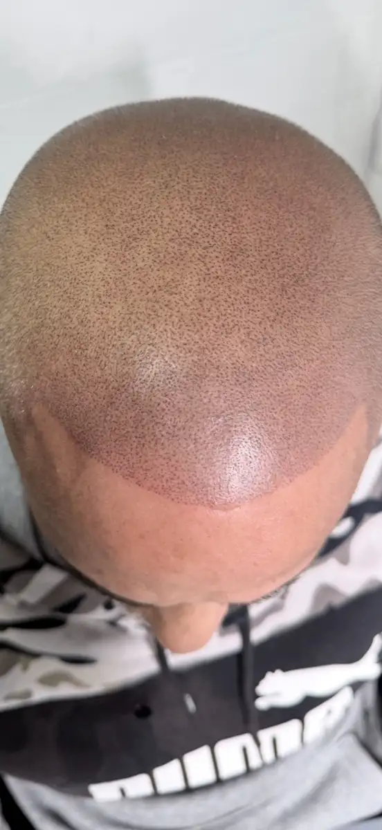 Completed full scalp SMP — front hairline view