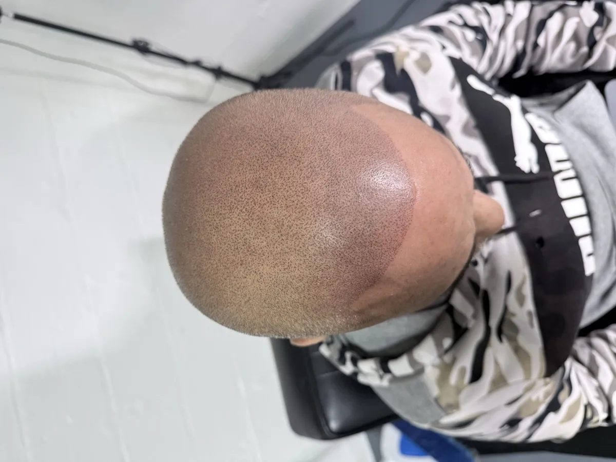 Completed full scalp SMP — top-down view