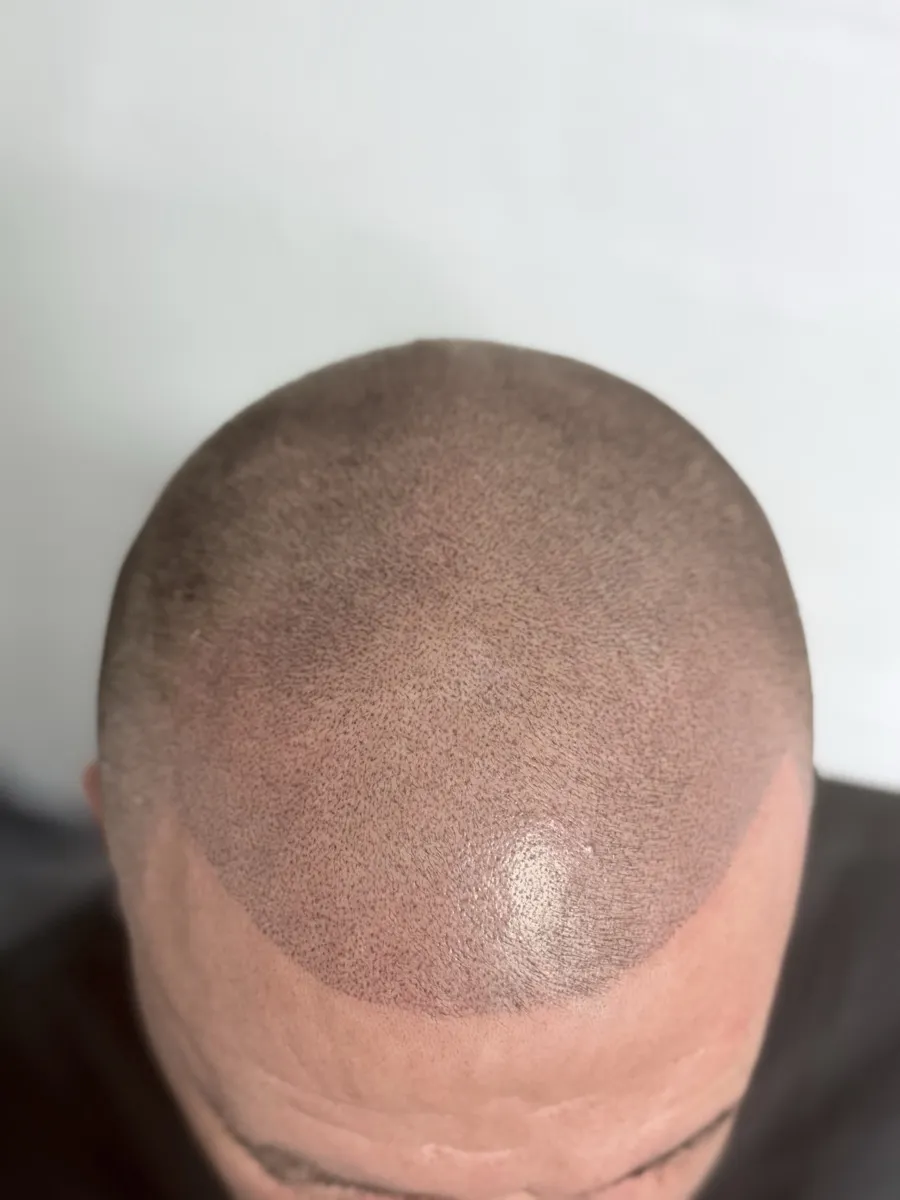 Completed full scalp SMP with scar camouflage — close-up result