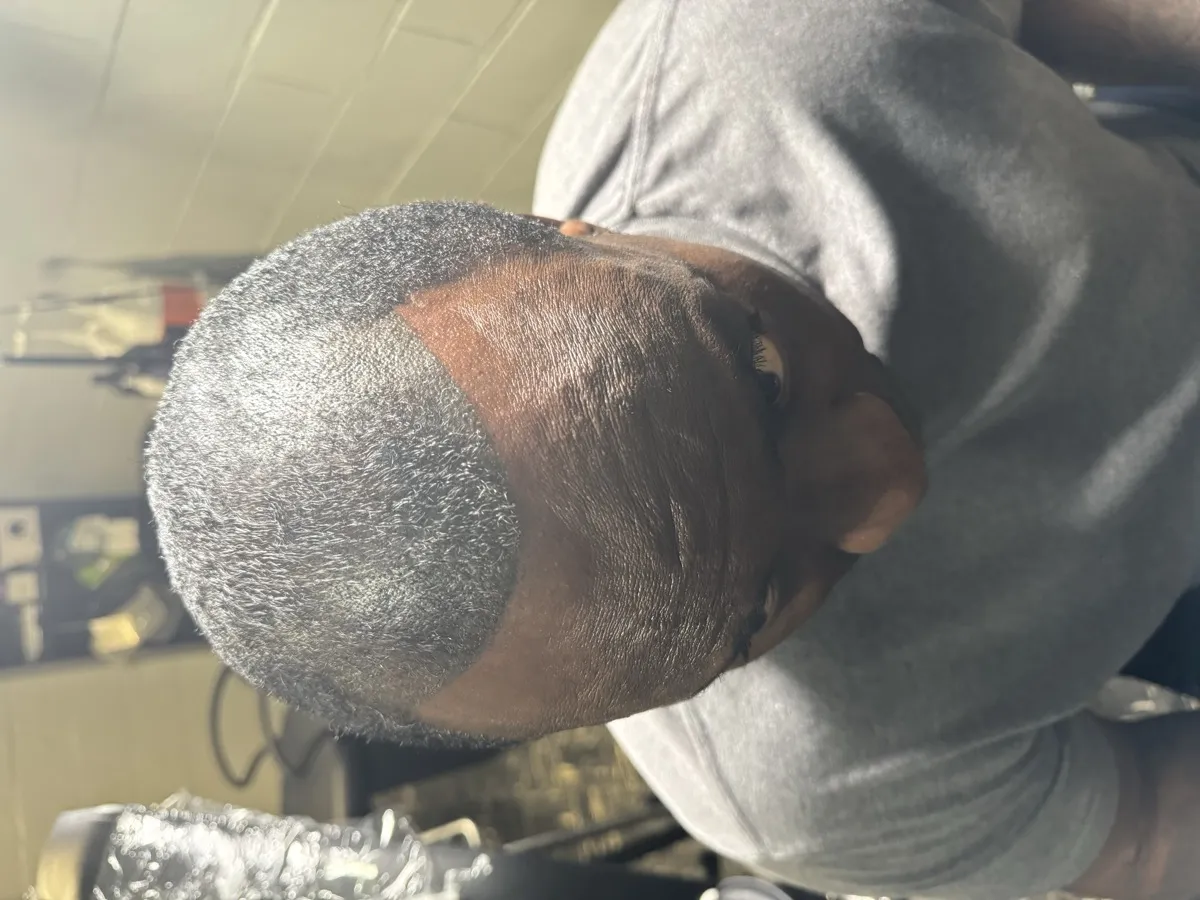 Density fill SMP — front view showing defined hairline