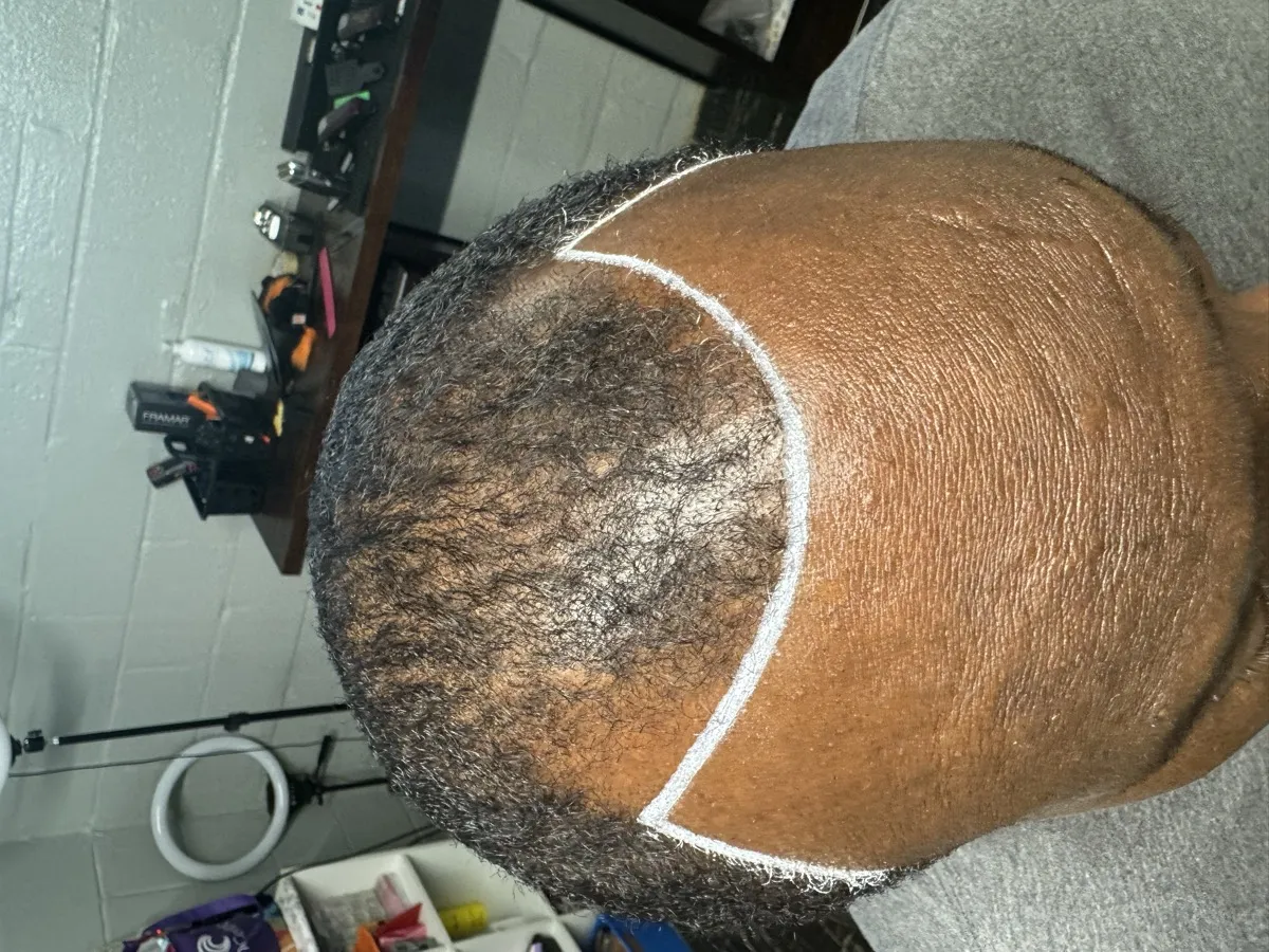 Before — thinning scalp with guideline markings