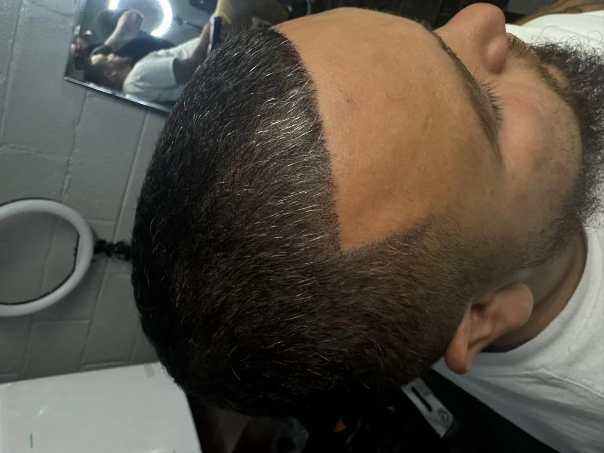 Hairline restoration — front view after SMP
