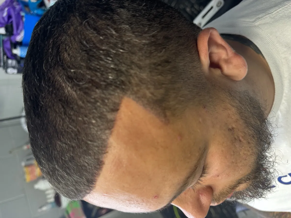 Hairline restoration — side profile after SMP
