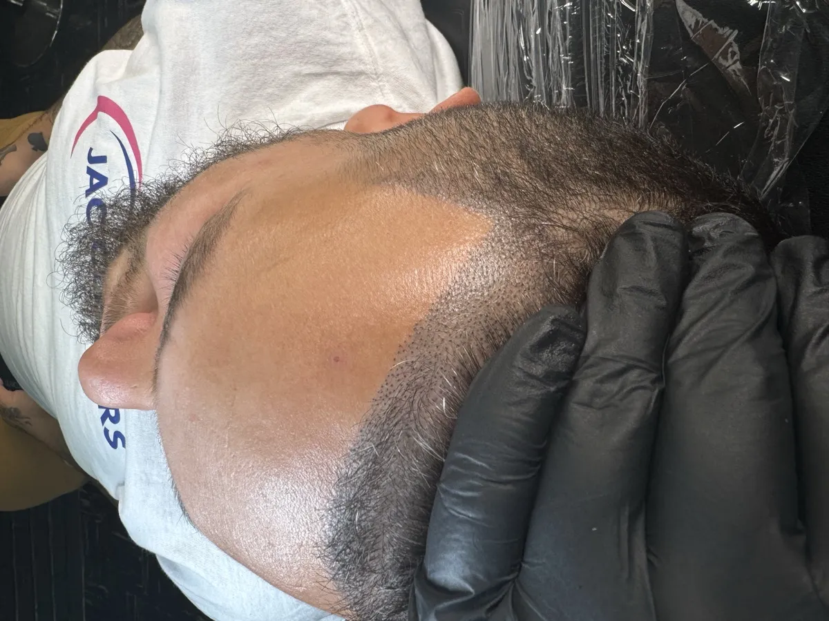 Before — receding hairline visible
