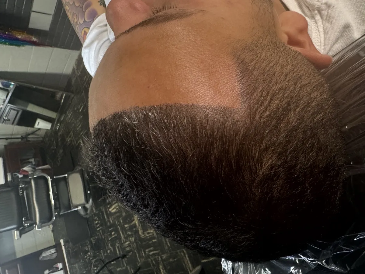 Before — thinning hairline from the side