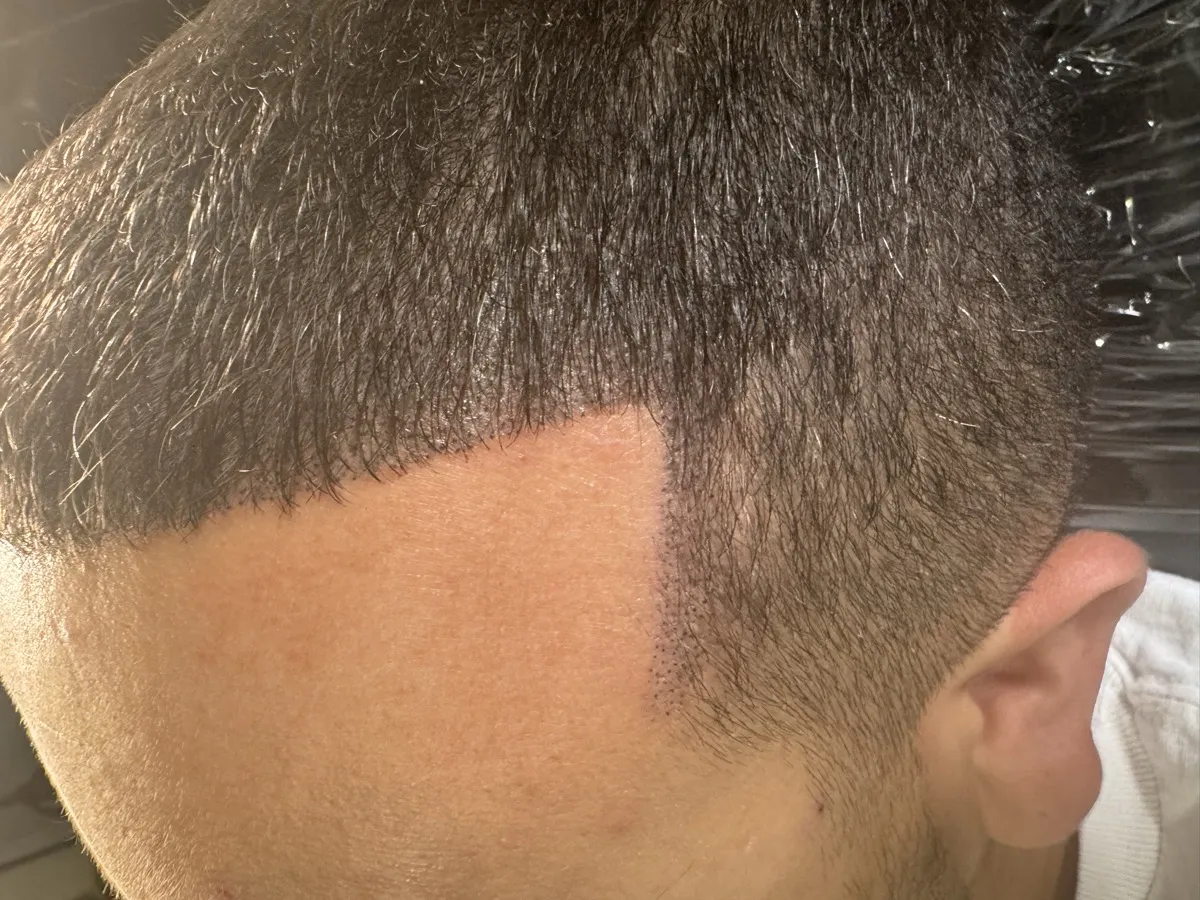 Half-and-half comparison showing SMP treatment vs natural scalp