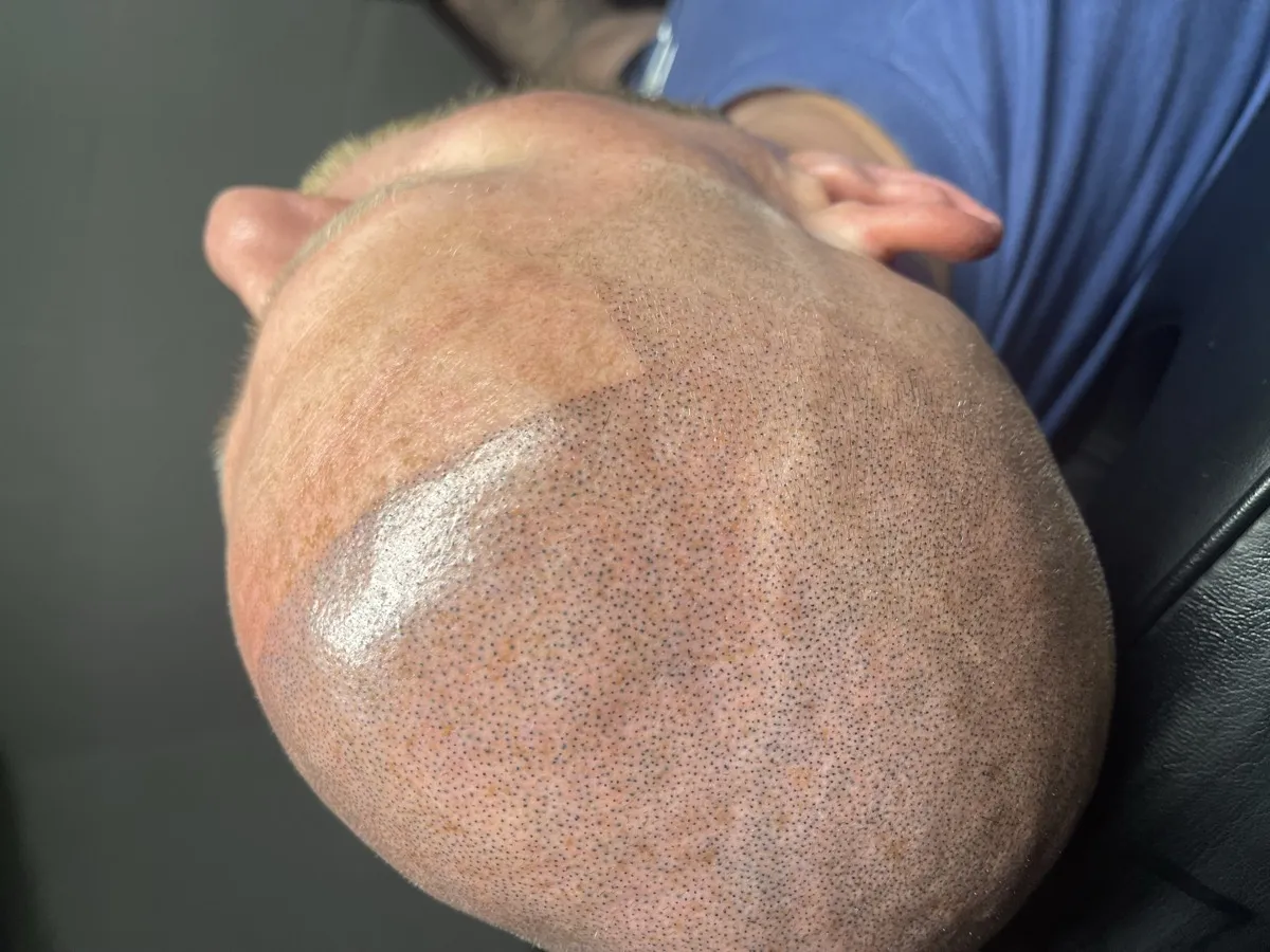 Full scalp SMP result — angled side view