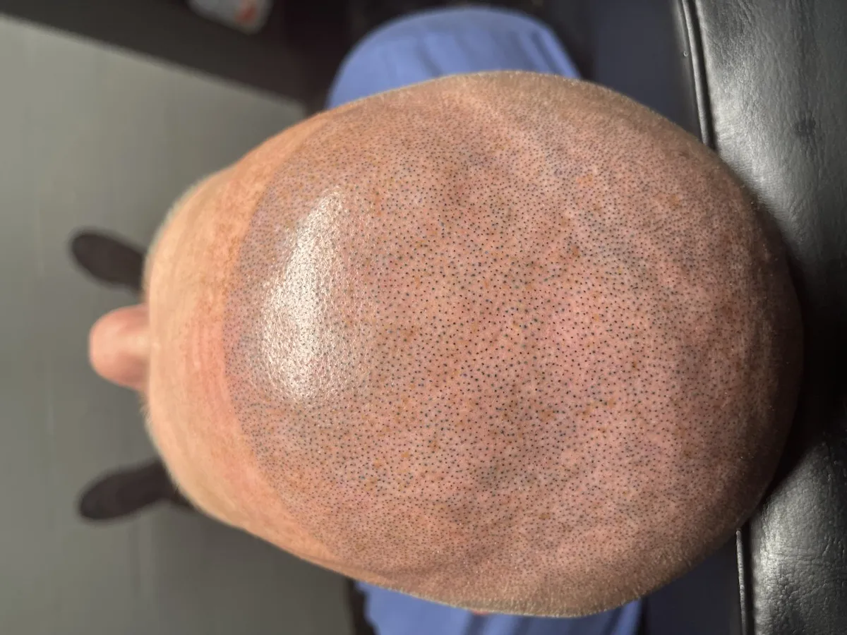 Full scalp SMP result — top-down view