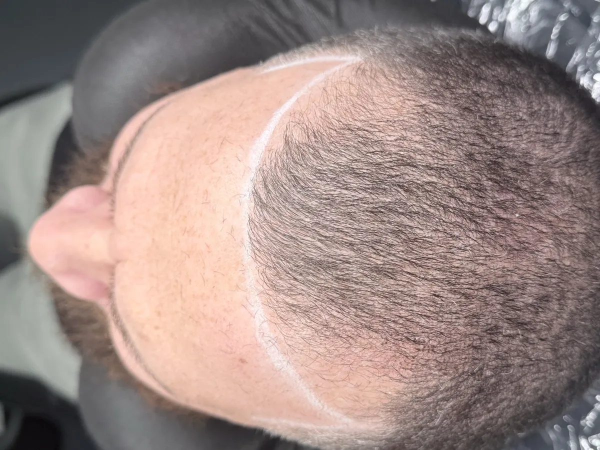 SMP session — hairline guideline markings front view
